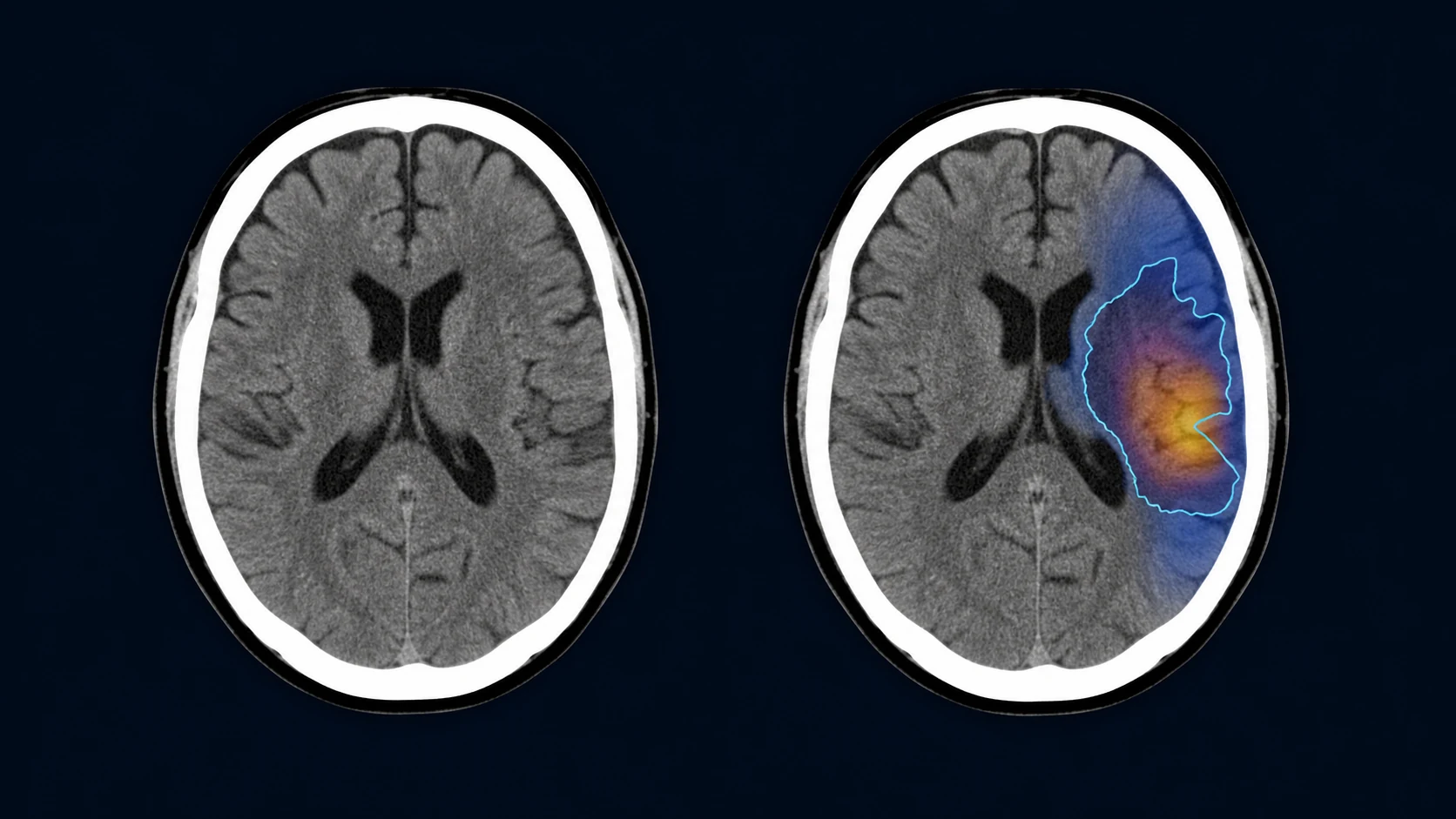 CT Stroke haemorrhage triage workstation