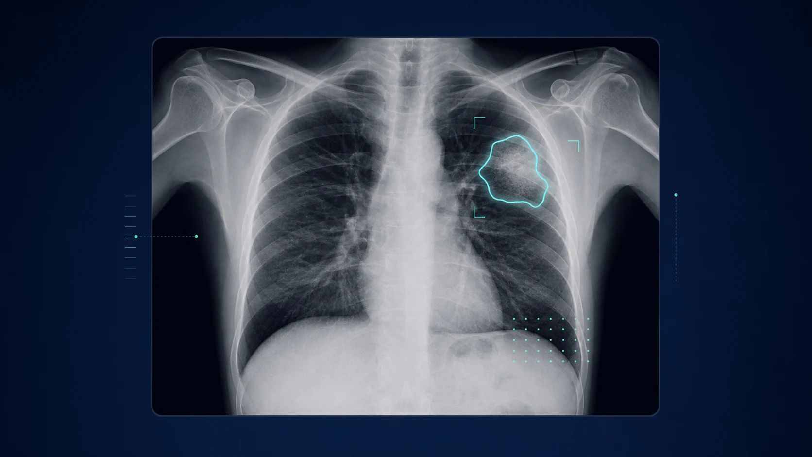 Conceptual illustration of AI-assisted chest X-ray screening